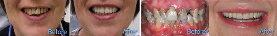 Before and After Dentures