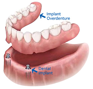 Implant Retained Dentures