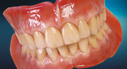 full-dentures-a