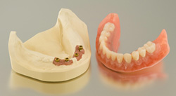 implant-retained-a