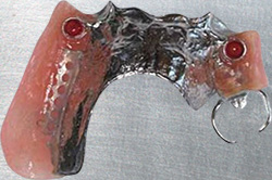 Implant Retained Denture