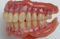 Lower Suction Dentures